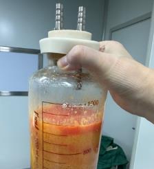安溪水动力吸脂手术要做多久？
